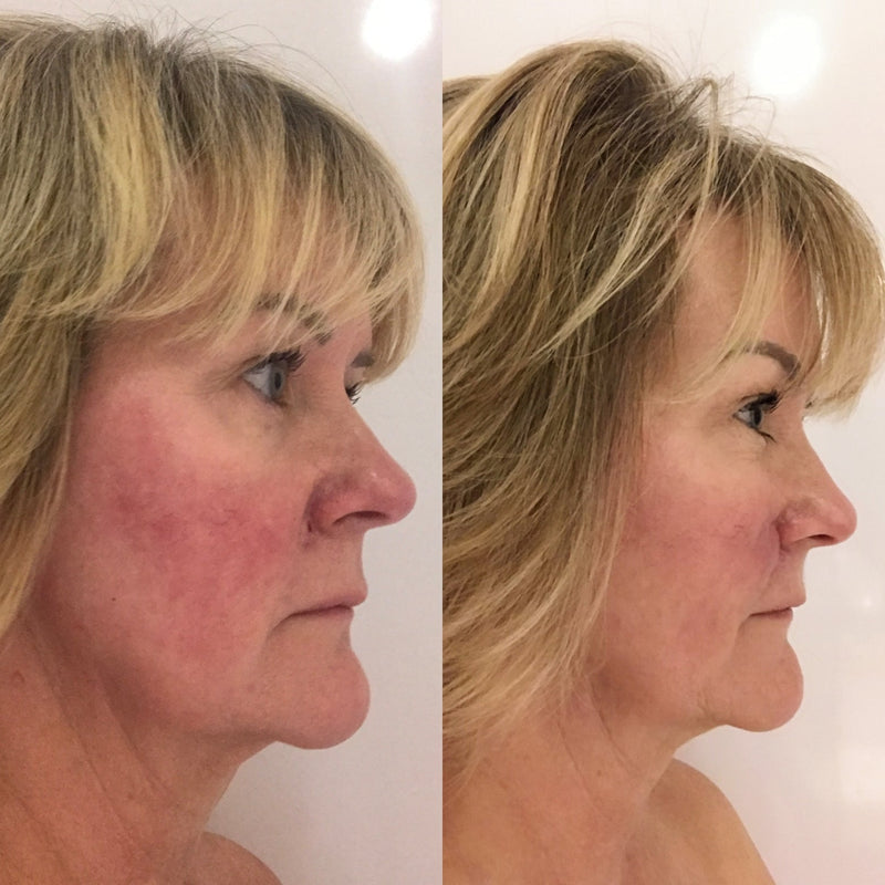 Rosacea Treatment Serum. Problem Skin Skincare